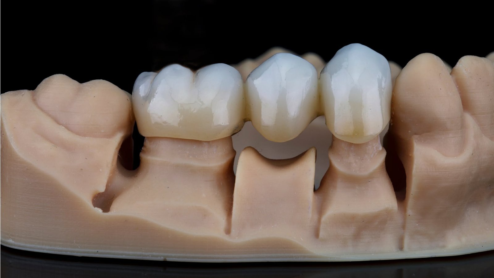 Three-unit dental bridge demonstrated on a dental model