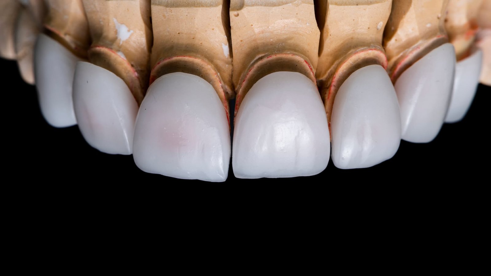 Front dental crowns demonstrated on a dental model