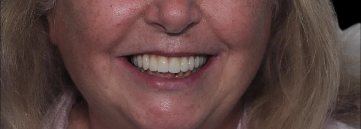 Smile after full-arch implant treatment