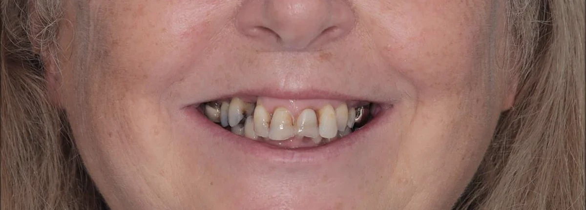 Smile before full-arch implant treatment