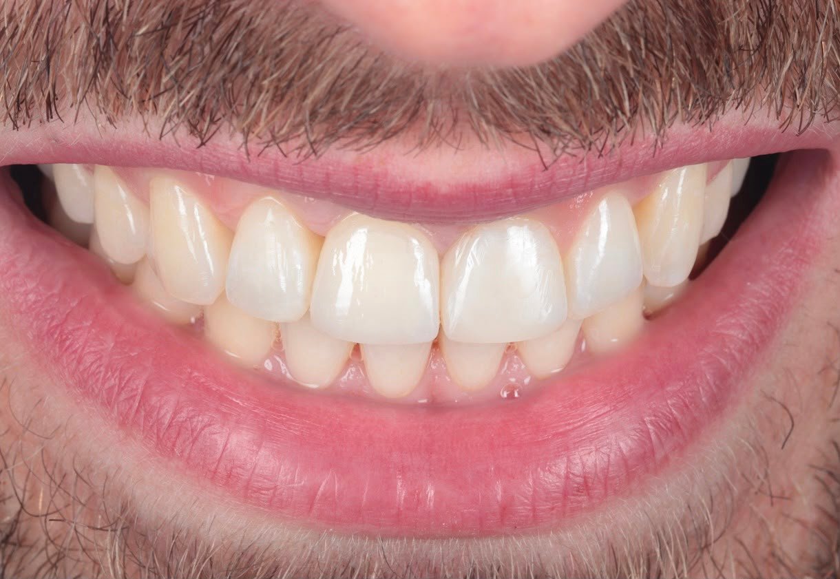 Restored front tooth after dental implant treatment