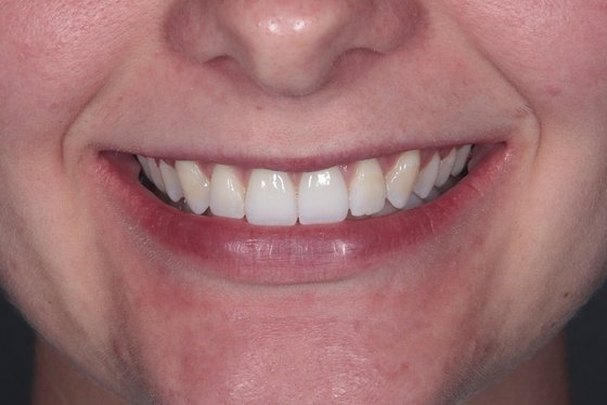 Smile after teeth-straightening treatment