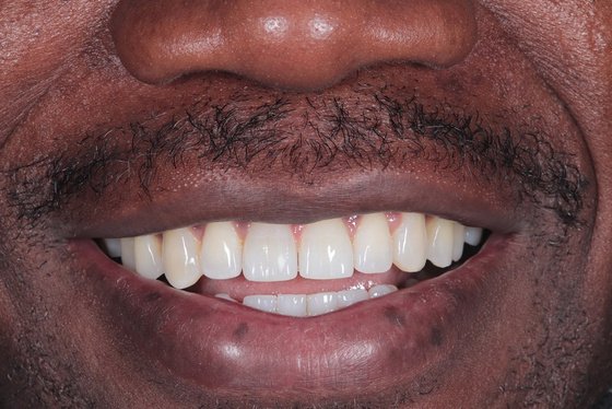 Teeth after a second alignment case
