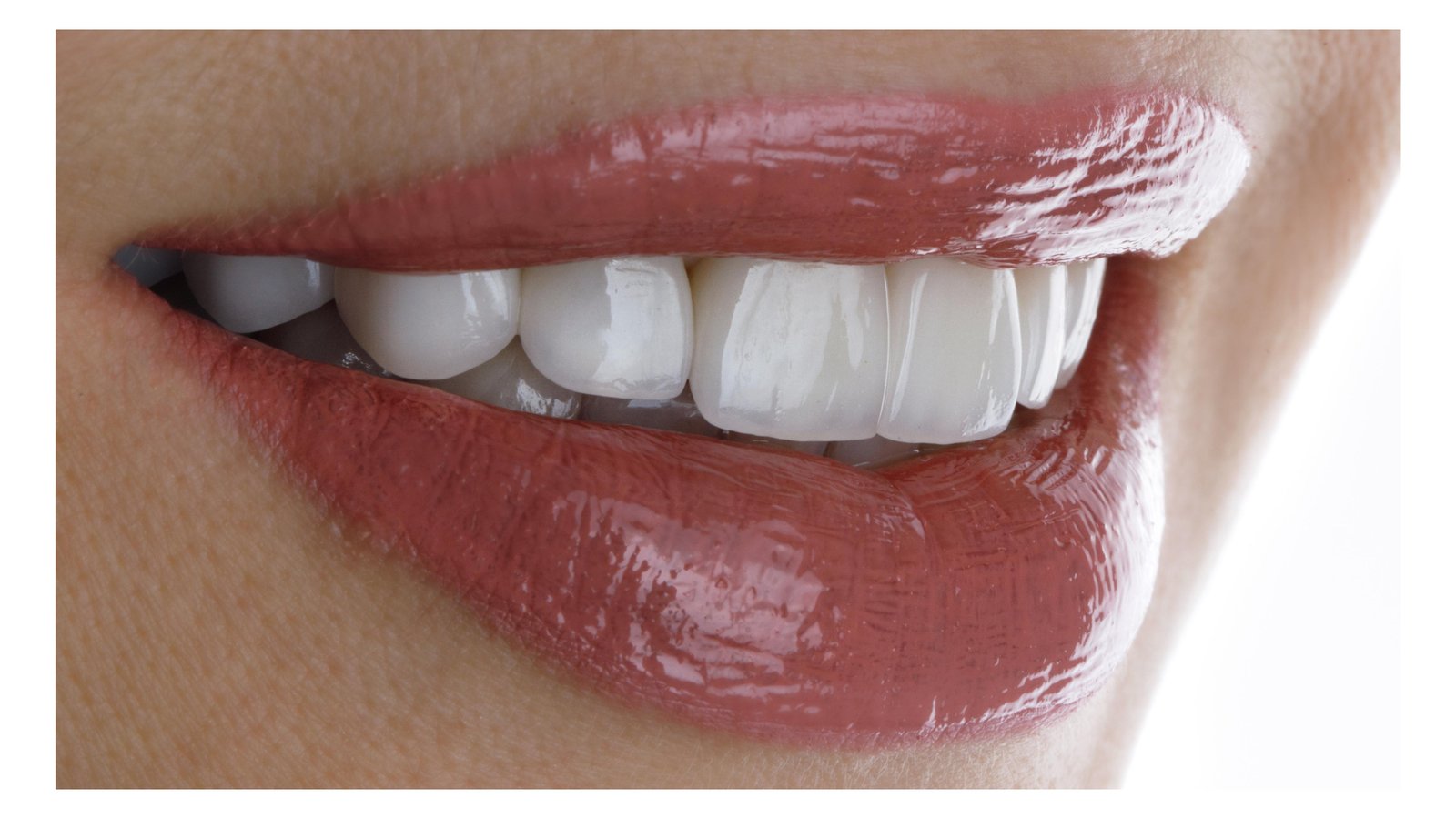 Close view of a bright smile illustrating porcelain veneer treatment